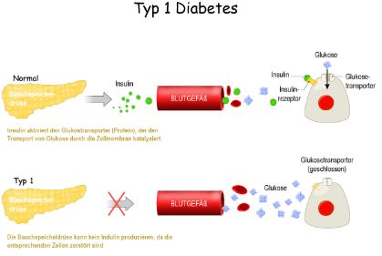 Grafik: Diabetes Typ 1