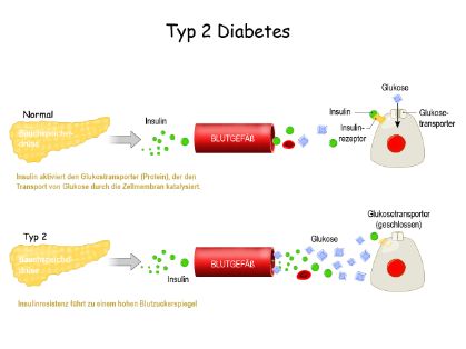 Grafik: Diabetes Typ 2