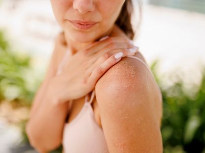 Bild: Frau mit schuppiger, gereizter Haut