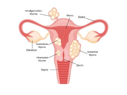 Grafik: Myome in der Gebärmutter