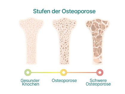 Grafik: Stufen der Osteoporose