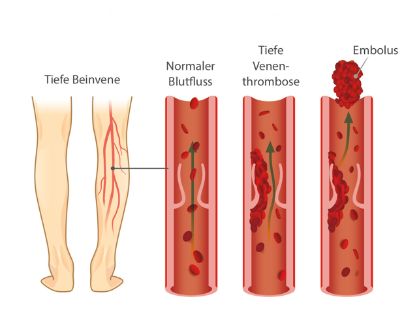 Grafik: Tiefe Beinvenen und Entwicklung Thrombose